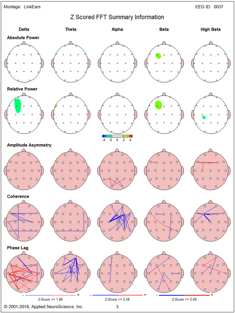 Figure 23 - Post-neurofeedback eyes-open NeuroGuide z-score FFT summary report showing reduced excess beta